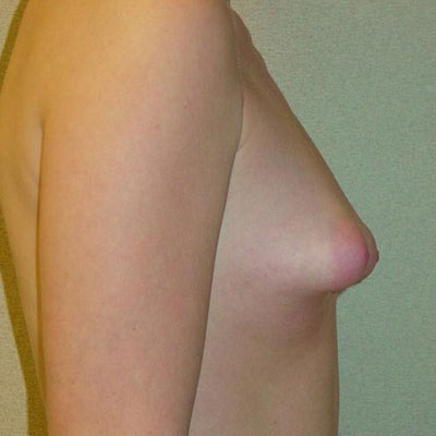 Tuberous Breasts Before Photo