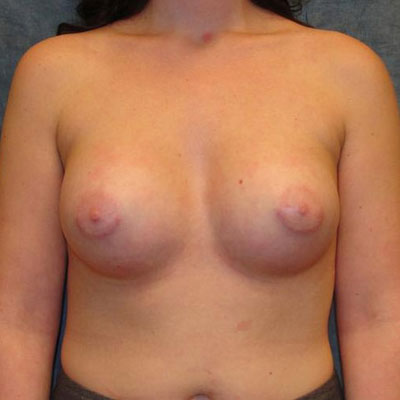 Tuberous breast augmentation before and after