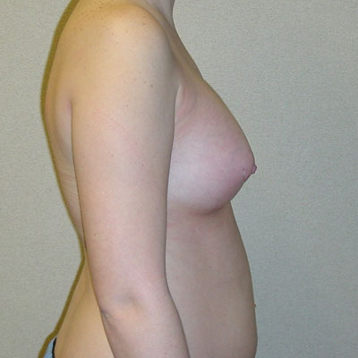 Tuberous Breasts After Photo
