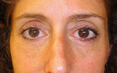 Lower Blepharoplasty Before and After patient 3