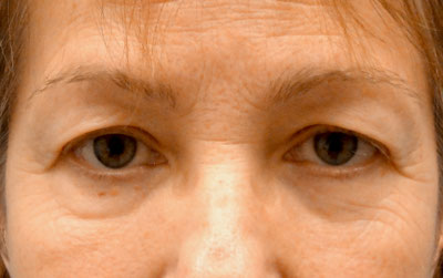 Upper Eyelid Surgery Before and After
