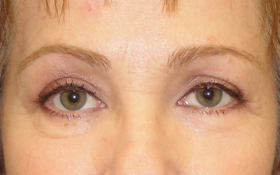 Upper Eyelid Surgery Before and After