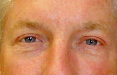 Upper Blepharoplasty Before and After patient 9