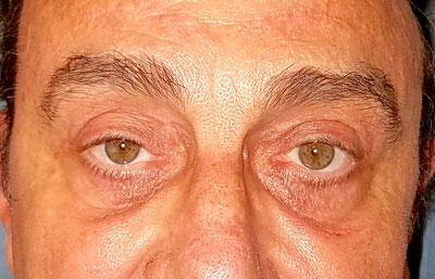 Upper Blepharoplasty Before and After patient 11