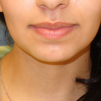 Chin augmentation before and after patient 2
