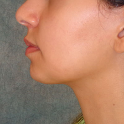 Chin Augmentation Before & After Image
