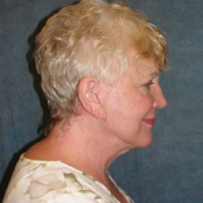 Facelift After Photo