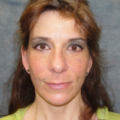 Facelift Before and After patient 4