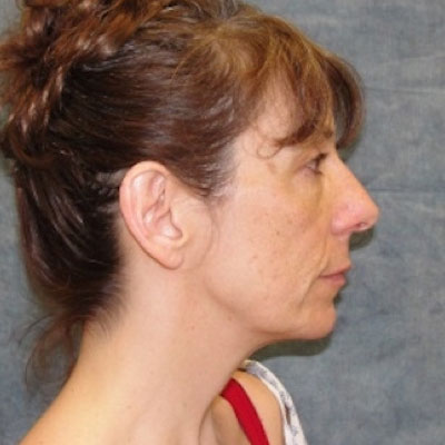 Facelift Before Photo