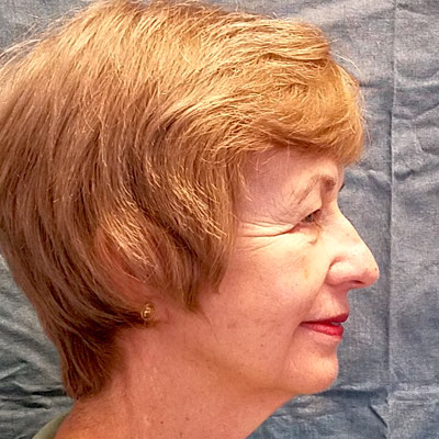 Facelift After Photo