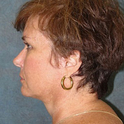 Neck Lift After Photo