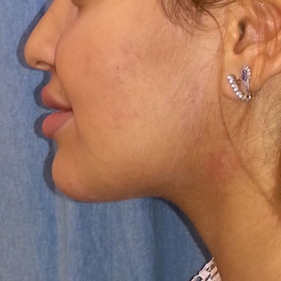 Neck Liposuction Before and After patient 3